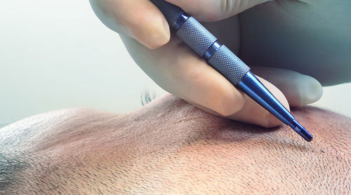 Neueste Unternehmensnachrichten über Die Anwendung von Saphirblättern bei der Haartransplantation
